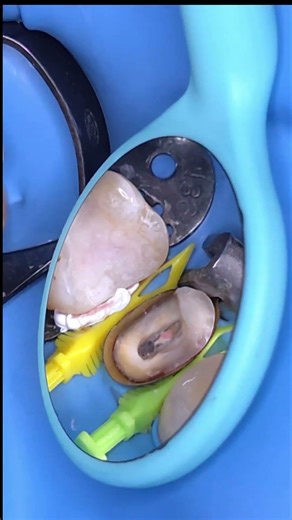 copper band with tofflemire matrix