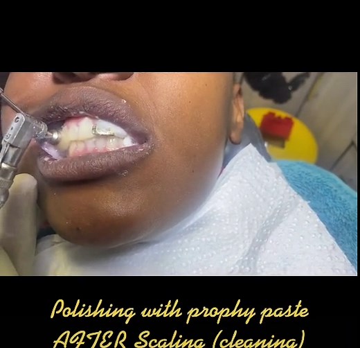Scale and polish /teeth clean and polish