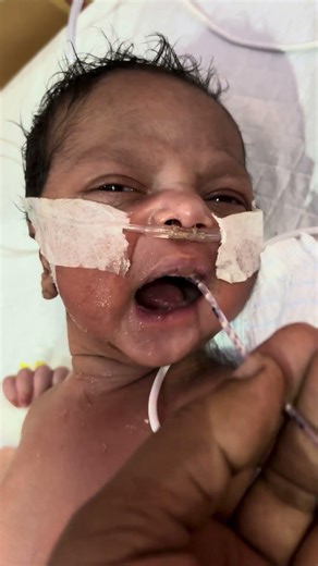 Newborn Baby NG Tube Insertion Process Explained #NewbornBaby #NGTube #NICUCare #BabyTubeInsertion