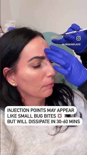 Full Face Botox Treatment