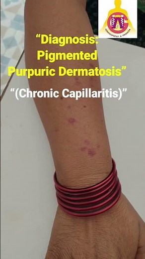 Why Do Purple Spots Appear Suddenly? | Capillary Fragility Explained