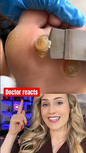 Doctor explains: callus removal