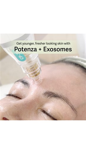 13K views · 30 reactions | The secret behind Tessa Nieto-Villalon's youthful radiance? Facial Care's new powerful duo: Potenza+ Exosomes! This innovative treatment combines RF microneedling with the power of exosomesto promote skin regeneration and enhance skin texture, firmness, and overall youthfulness. Find out more about Potenza + Exosomes by sending us a DM! | Facial Care Centre | Facebook