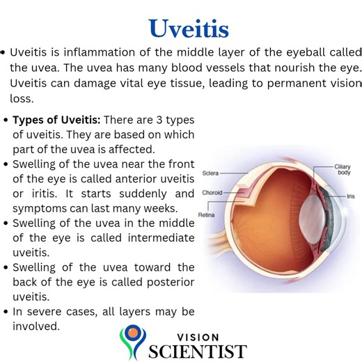 UVEITIS is inflammation of the middle layer of the eyeball called the uvea. The uvea has many blood vessels that nourish the eye. Uveitis can damage vital eye tissue, leading to permanent vision loss. THREE TYPES OF UVEITIS: There are 3 types of uveitis. They are based on which part of the uvea is affected. Swelling of the uvea near the front of the eye is called anterior uveitis or iritis. It starts suddenly and symptoms can last many weeks. Some forms of anterior uveitis are ongoing, while oth