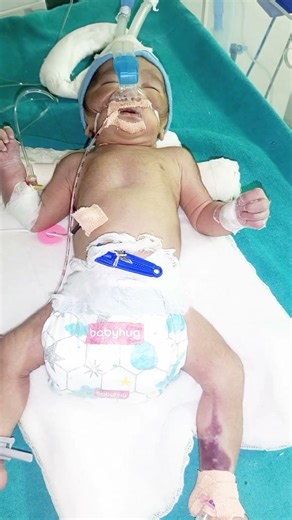 CPAP Support for Newborn | NICU Journey 🏥 #medical #neonatalcare #baby #nicu #niculife #protocol