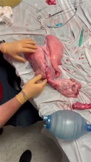 Alveoli "recruitment", filling with air. Also the importance of PEEP. #EMT #Paramedic #EMS #Nurse