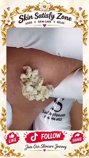 Deep Blackhead Extraction & Satisfying Popping | Wait for the most satisfying pop 😳🫣 You won’t believe what comes out! #pimplepoppersatisfying #Acne #pimple #Blackhead #Satisfying