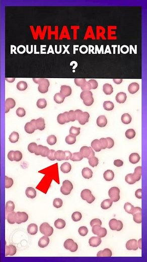 What Is “Rouleaux Formation” 🩸? | Clear Explanation