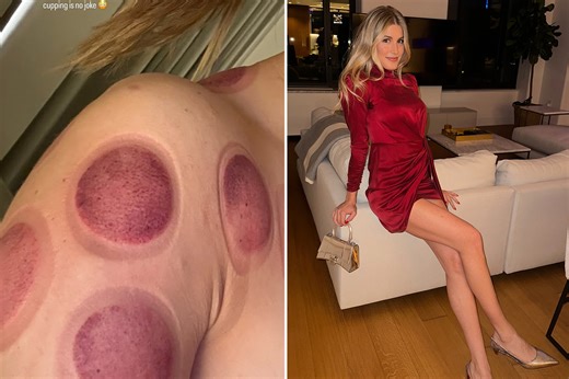 Bouchard shares gory snap of cupping treatment after stunning in leggy red dress