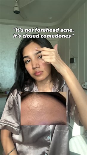 Dr. Moksha Rathore | Skin & Hair Doctor on Instagram: "Let me help you ⬇️ If you have even 3 of the symptoms from the reel , you might not have just forehead acne , it might be closed comedones So it can be due to: - Dead skin cell buildup - Dandruff (very common) - Too heavy cream / serums - Loading your skin with multiple step products Now coming to how to treat this👇 1. Use all non comedogenic skincare/ makeup (very important) 2. Treat your dandruff asap (just type ‘acne’ & I will send shamp