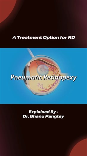 Dr. Bhanu Pangtey on Instagram: "Retina detachment has more than one treatment option. In early cases, a simple gas injection (Pneumatic Retinopexy) can help reattach the retina and protect vision. ⚠️ Early symptoms should never be ignored. Follow for real eye-health awareness 👁️ #RetinaDetachment #EyeHealth #doctorexplains"