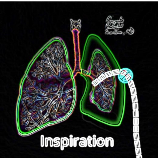 Pneumothorax Treatment explained in 1 minute