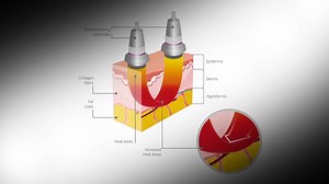 LipoMax #BodyContouring #ByeByeCellulite #MiamiComesToLatinAmerica | Estetique USA