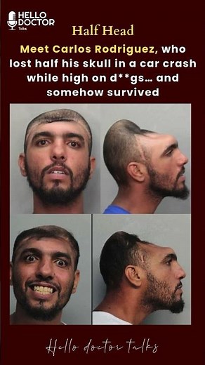 Meet Carlos Rodriguez, who lost half his skull in a car crash #carcrash #cars #health #skull