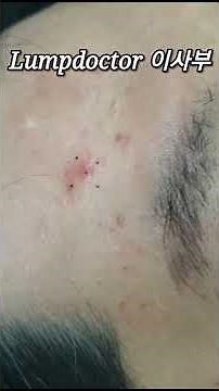 Blackheads, acne, epidermal cysts, pimples, boils