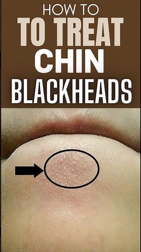 Remove Nose & Chin Blackheads at Home ✨ Blackheads Gone in Minutes 😳 #skincare #blackheads