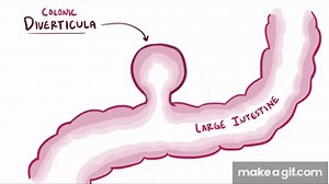 Diverticula, diverticulosis, & diverticulitis - causes, symptoms & pathology on Make a GIF