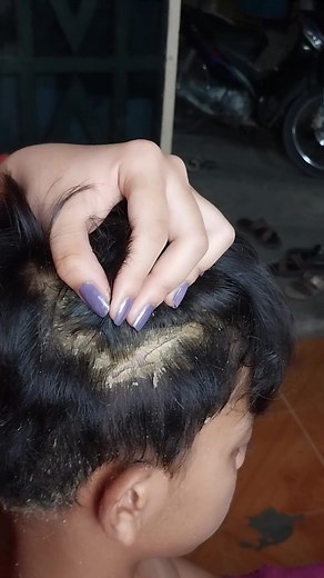 14K views · 83 reactions | Amazing Removal dandruff on black combing brother scalp no itchy Part 4 | Showerer | Facebook