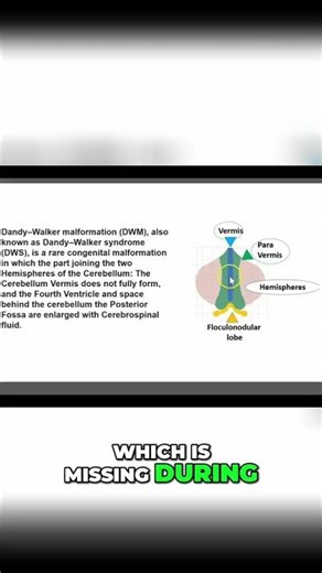 Cerebellum Malformation: Understanding Dandy-Walker Syndrome #shorts