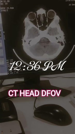 CT HEAD DFOV #trending