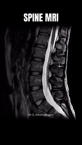 16K views · 5K reactions | The basics of a spine MRI. This is a T2 weighted sagittal MRI of the lumbar spine. #anatomy #spine #neuroanatomy #neuroscience #science #medical | Dr.Z Neurosurgery | Facebook