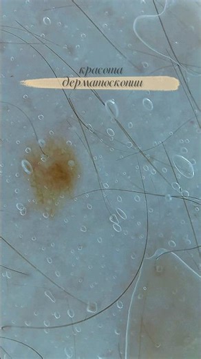 🖤 #oncology #онколог #dermatoscopy #дерматоскопия