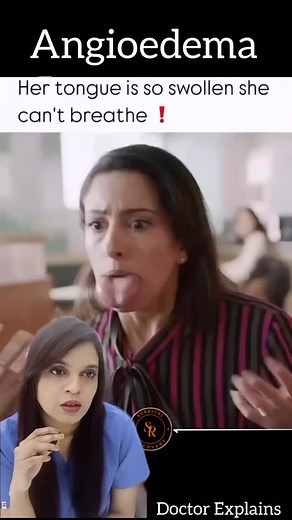 Dr Ramya Shrideep N | ENT, Sleep & Cosmetic Surgeon 🔵 on Instagram: "Types of Angioedema – Know the Difference! Allergic Angioedema: Triggered by allergens like food, insect bites, or medications. Hereditary Angioedema (HAE): A rare genetic condition caused by low levels of C1 inhibitor protein. Drug-Induced Angioedema: Common with ACE inhibitors used for blood pressure. Idiopathic Angioedema: Cause unknown; often recurring. Acquired Angioedema: Usually in adults; may be linked to autoimmune is