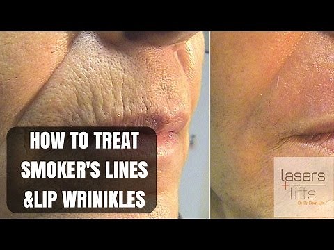 How to treat upper lip wrinkles and smoker's lines