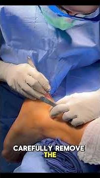 Haglund’s Deformity & Achilles Repair Surgery | Houston Foot & Ankle Surgeon #podiatry #houston