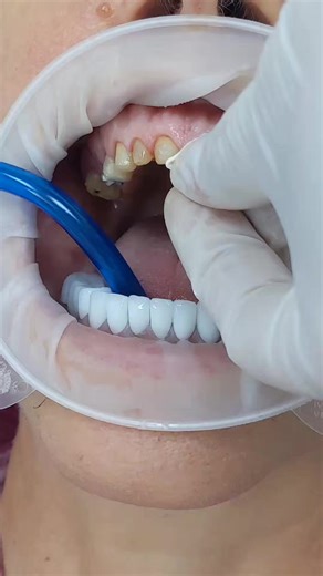 Temporary Cementation of Metal Ceramic Crowns