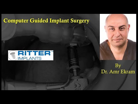Computer guided Surgery By Dr Amr Ekram using Ritter implant system (A full digital workflow)