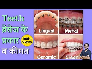 Types of Teeth Braces and Their Cost in Indore