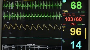 clip-17172313-ekg-monitor-icu-unit-show-waves-blood