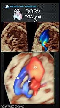 TGA-Type DORV with Pulmonary Stenosis | Key Echo Findings & Concepts