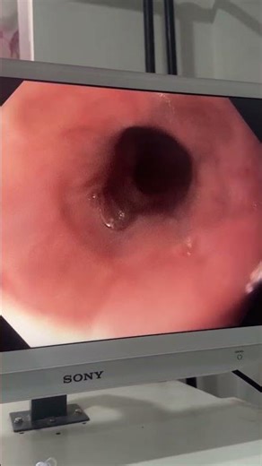 Esophageal varices in an adult male with during Upper GI Endoscopy #varices #esophageal #veins