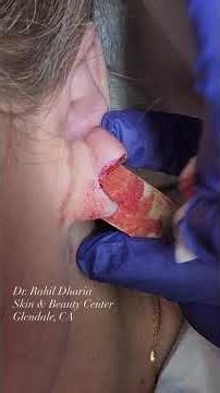 Satisfying Earlobe Repair Transformation | Skin & Beauty Center
