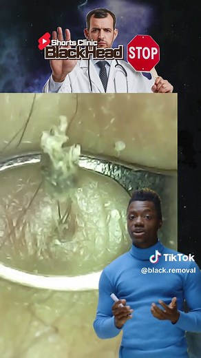 big monster Blackheads #ヤバすぎる角栓 #角栓 #角栓除去 #角栓抜き #毛穴 #粉瘤 #bigblackheads #pimple #satisfying #blackheadextraction #skincare #squeeze #squeezeyuk #acne #pimple #pimplepop #blackhead #satisfying #ديرمابن # تقشير #الخلطه_السحريه #تنظيف_البشرة #保養 #無痛清粉刺 #清粉刺找肌秘 #療癒 #療癒影片 #男生保養 #男生清粉刺 #推薦 #做臉 #舒服 #earblackhead #角栓好きと繋がりたい #pore #ニキビ #角栓好きと繋がりたい #espinhas #satisfatório #pimples #ขึ้นฟีดเถอะ #เปิดการมองเห็น #สิว #สิวเสี้ยน #สิวหัวดำ #สิวอุดตัน #สิวหัวขาว #กดสิว #保養 #無痛清粉刺 #清粉刺找肌秘 #療癒 #療癒影片 #男生保養 #男生清粉刺 