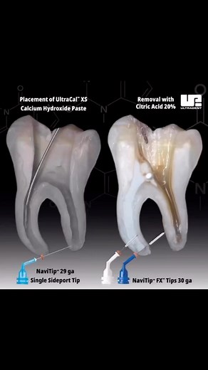 Dental Mentor Pro ®️ on Instagram: "🦷 • UltraCal™ XS paste elevates the dentin pH to alkaline, making it the ideal 💡medium to be used as an interappointment dressing in clinical situations involving root resorption, dressing material, pulp capping, apexification and perforations. Ultradent Citric Acid is a mild acidic🧪 material that is effective at dissolving/cleaning calcium hydroxide from canals (e.g., UltraCal™ XS calcium hydroxide paste). It is also recommended as a cleanser/conditioner t