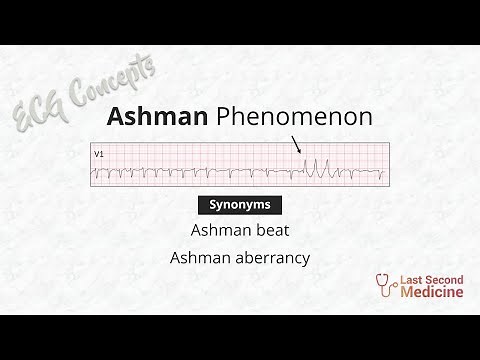 Ashman phenomenon | Ashman Beat | Ashman Aberrancy