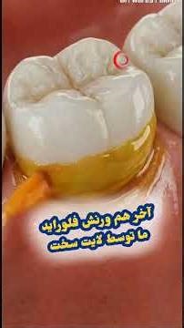 dentin hypersensitivity #dentist #teethdecay #teethdecay #dentalcare