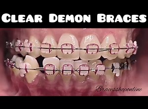 2.2K views | Their clear brackets make them more aesthetically pleasing because they are virtually invisible, making them much less noticeable than traditional braces. Faster Treatment: Patients with Damon braces finish over seven months before those with conventional braces. #bracestrendingcolor #bracestipsandadvice #fypシ #dentalideas #braceslife #bracescare #everyone #highlights | Braces Shop Online | Facebook