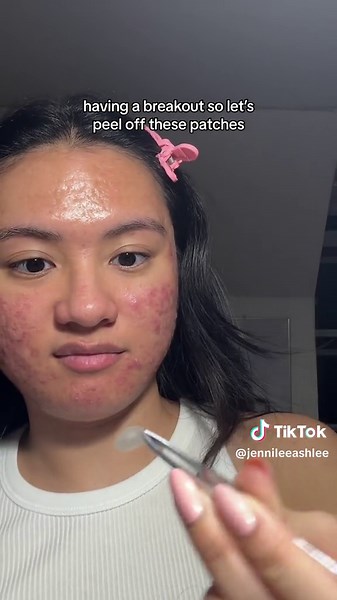 Peeling Off Acne Patches for Breakout Skincare | Fun and Effective Pimple Patch Removal