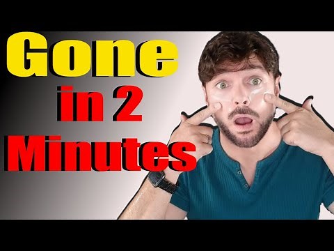 Under Eye Bags Treatment That Works in 2 Minutes! | Chris Gibson