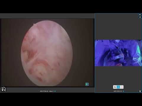 Enbloc HoLEP (Dr Elshal AM) live surgery