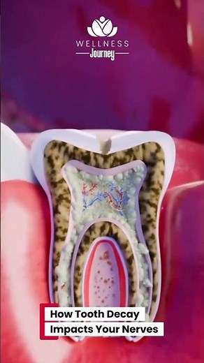 How Tooth Decay Impacts Your Nerves 🦷💢​🤯