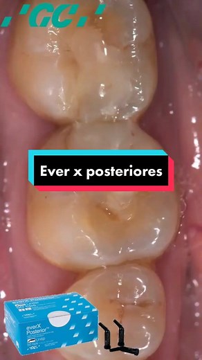 El video es una demostración del uso de GC EverX. GC everX Posterior es un composite reforzado con fibra diseñado para utilizarse como sustitución de la dentina, junto con un composite convencional como G-ænial Posterior utilizado como sustitución del esmalte. #dentista #odo #solucionesdentales🇧🇴 #sc #esteticadental