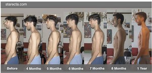 Lumbar Lordosis: How to Solve it permanently? - Starecta