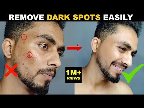 DARK SPOT कैसे हटाये | How To Remove DARK SPOTS & SCARS *NATURALLY* ACNE SCARS, ACNE MARK | 2021