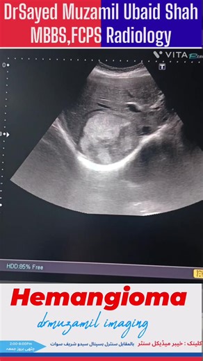 Liver Hemangioma. #drmuzamilimaging #ultrasound #liver #sgpt #hemangioma