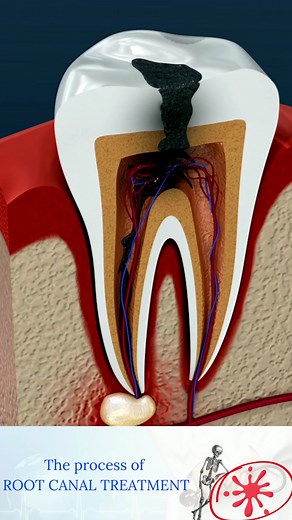 39K views · 702 reactions | #rootcanal #RootCanalTreatment...